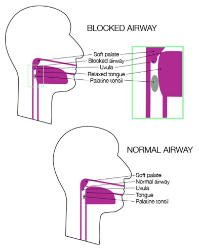 sleep-apnea-mclean-va