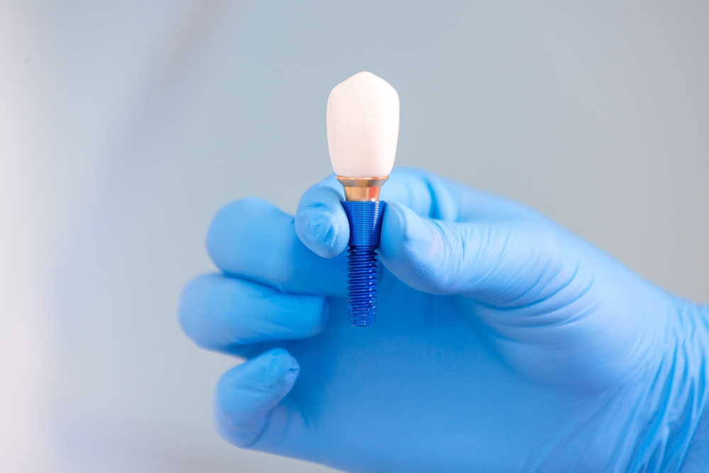 dental implants service
