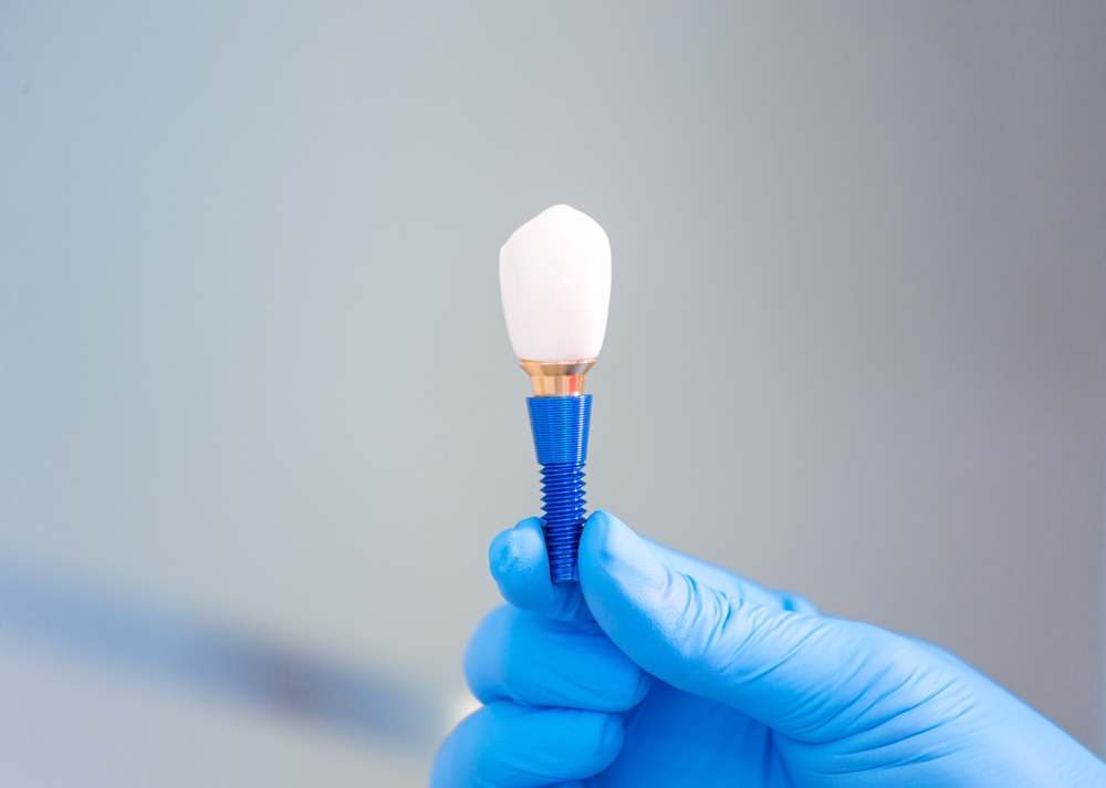lost a tooth? what to know about dental implants