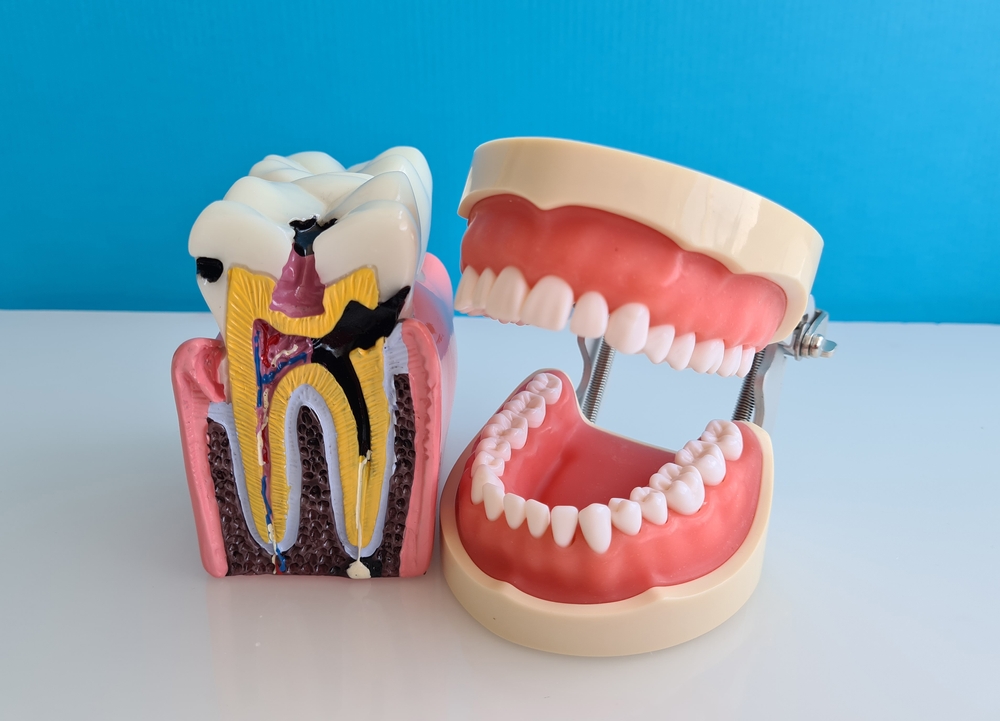 root canal therapy service